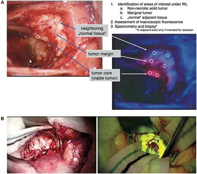 Indocyanine-Green for Fluorescence-Guided Surgery of Brain Tumors: Evidence, Techniques, and Practical Experience
